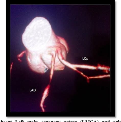 Figure 2 From Evaluation Of Anatomic Variations In Coronary Artery On