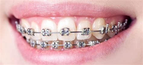 What Everyone Should Know Before Getting Dental Braces Dental