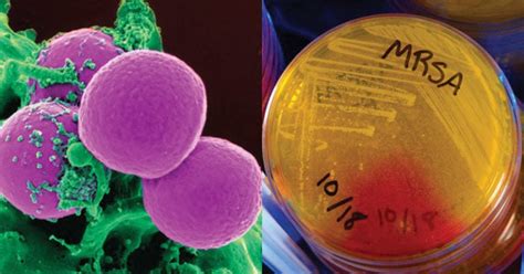 Methicillin Resistant Staphylococcus Aureus Mrsa