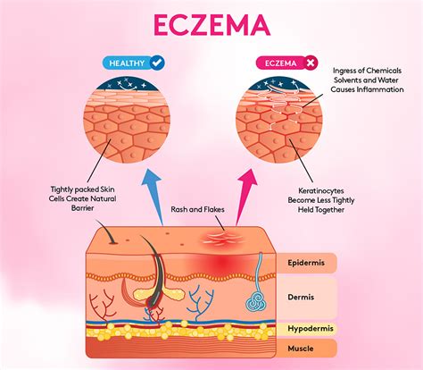 List 91 Pictures Eczema In Groin Area Pictures Stunning