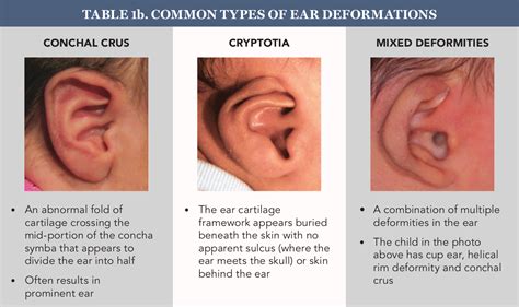 Non Surgical Correction For Childhood Ear Deformities
