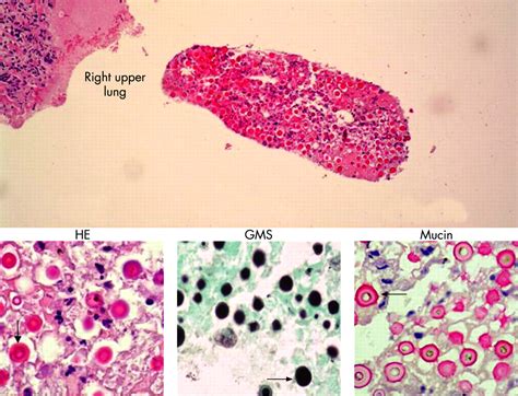 Pulmonary Cryptococcosis Mimicking Solitary Lung Cancer In An