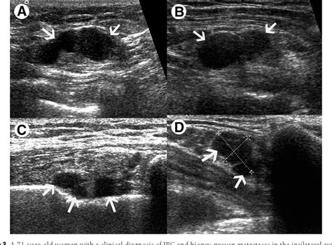 Figure 1 From Sonographic Features Of Inflammatory Breast Cancer