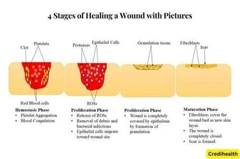 4 Stages Of Healing A Wound With Pictures Credihealth