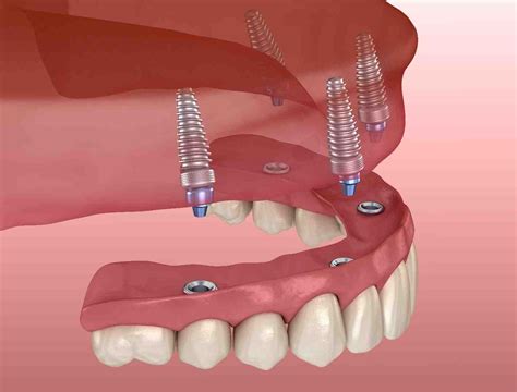 Is There Any Dental Insurance That Helps Cover Mini Implants Dental