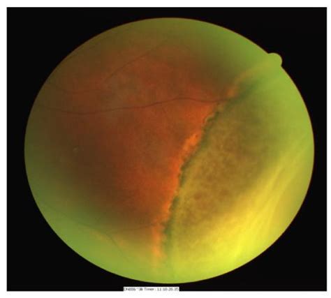 Fundus Photograph Of The Same Eye Demonstrating Peripheral Retinal