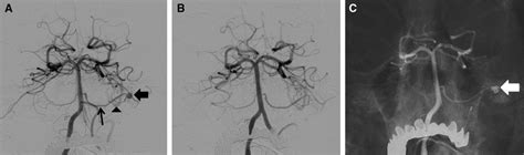 Management Of Brain Arteriovenous Malformations A Scientific Statement For Healthcare