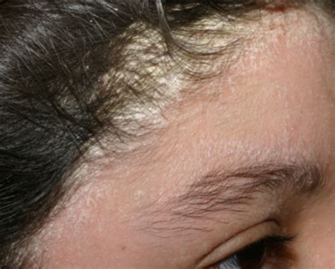 Seborrheic Dermatitis Blog Vibrant Dermatology And Skinbar Md