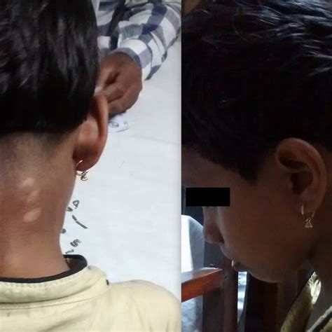 Swelling At The Posterior Neck Region Overlying Skin Appears