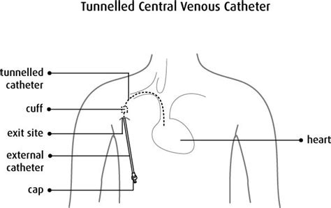 Superb Tips For Tunneled Central Venous Catheter Cpt Codes Medical