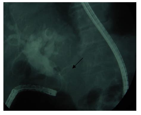 Therapeutic Ercp Stone Extraction After Biliary Balloon Dilatation