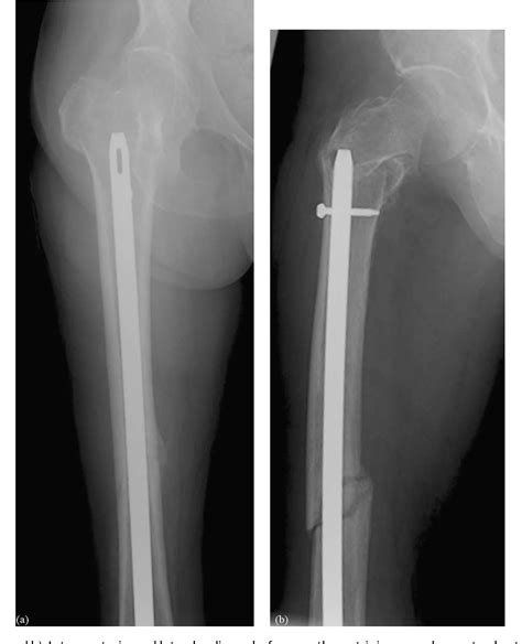 Figure 3 From Pertrochanteric Femur Fracture At The Proximal End Of A
