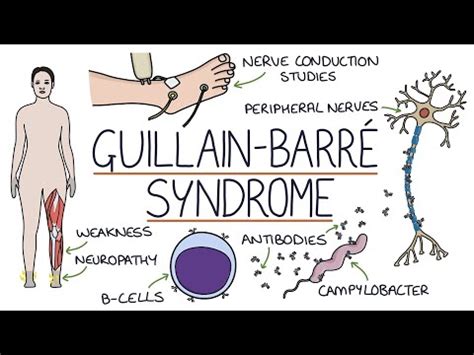 Guillain Barre Syndrome Kalusugan 2023