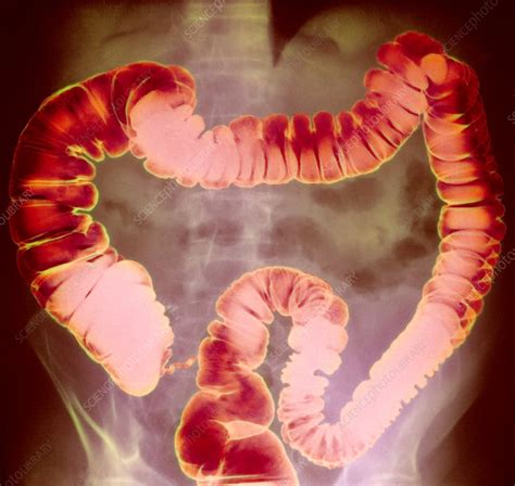 large intestine x ray stock image p560 0147 science photo library