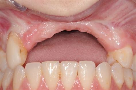 Severe Loss Of Upper Jaw Bone Grafted For Dental Implants Kazemi Oral