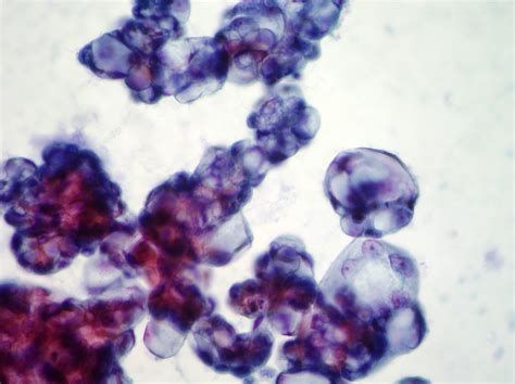 Maybe you would like to learn more about one of these? Effusions Cytopathology | Cellnetpathology