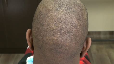 Fue Hair Transplant Surgery Scar Follow Up After 1 Year By Drdiep