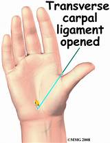 Images of Endoscopic Carpal Tunnel Release Recovery Time