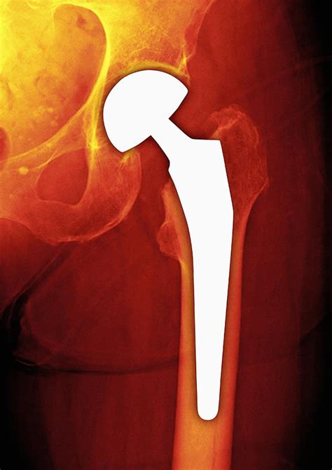 Total Hip Replacement X Ray Photograph By Miriam Maslo