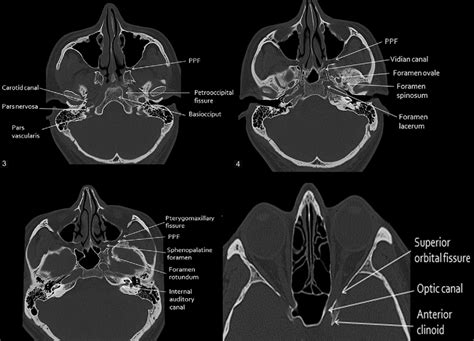 Nasal Bone Anatomy Ct Axial