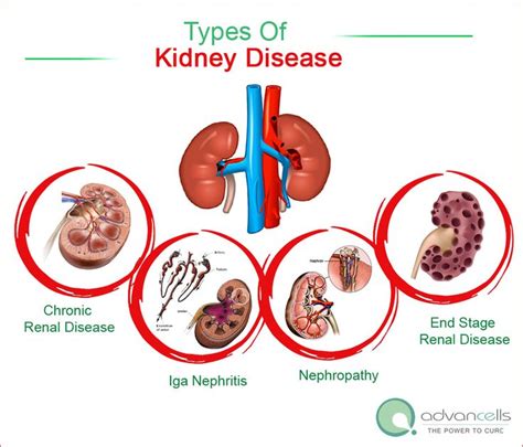 Types Of Kidney Disease Chronic Renal Disease Iga Nephritis