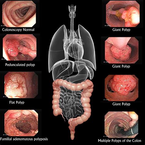 The colon (:) marks a bigger pause than that is expressed by the semicolon. Polyps - Notes on Cyber Gastroenterology - murrasaca.com