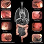 Colorectal Cancer - Notes on Cyber Gastroenterology - murrasaca.com