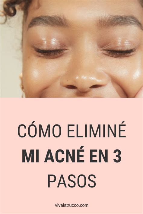 Como Eliminar Acne Molesto Eliminar Acne Elimina Acne Rapido Korean