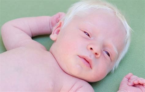 Albinizm Czym Jest Przyczyny Objawy I Leczenie Poradyfit Hot
