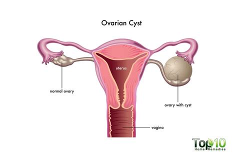 ovarian cysts dr sorkin