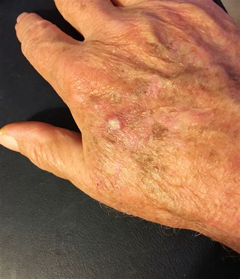 Actinic Keratosis Pre Cancers Dermatology And Laser Center Of Charleston