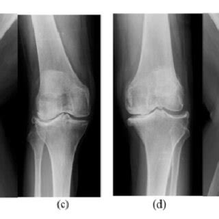 A Year Old Female With Osteoarthritis Of Knee With Windswept Download Scientific Diagram