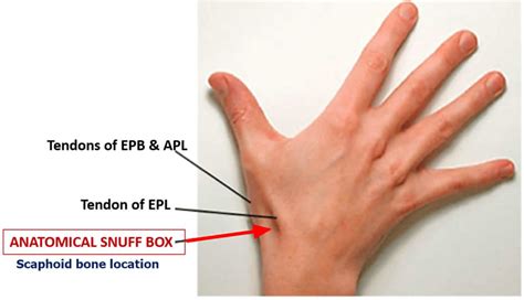 Scaphoid Fracture Causes Symptoms Diagnosis Treatment Revovery Time