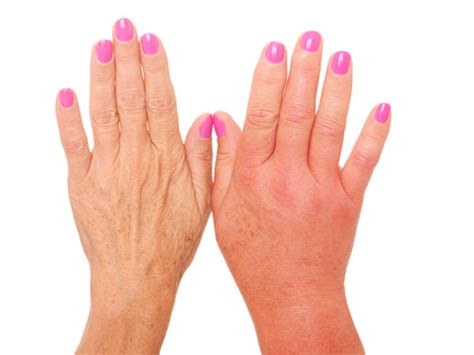 12 Early Signs Of Poor Blood Circulation