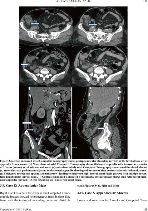 Computed Tomography Diagnosis Of Acute Appendicitis—pictorial Essay