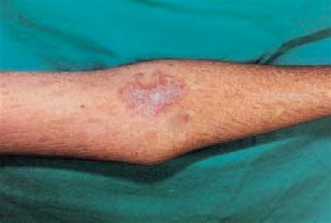 Hyperkeratotic Plaques On The Elbow Crease Download Scientific Diagram