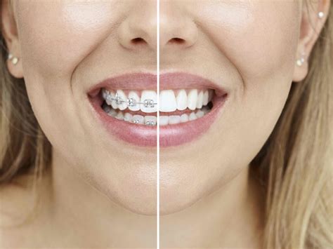 Por Que Ter Os Dentes Alinhados Dental Expert