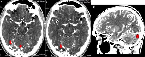 Contrasted Brain Ct In Axial Section Ab Dilated Vessels Are