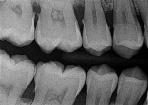 How To Take Perfect Dental X Rays 7 Tips And Tricks