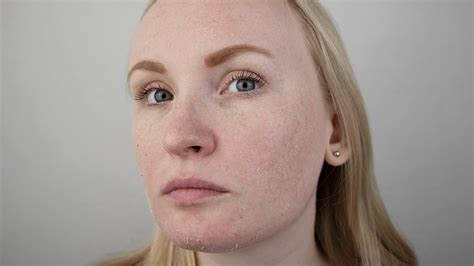 Почему шелушится кожа на лице причины что делать убрать шелушение