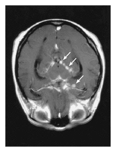 Tuberculous Meningitis — Nejm