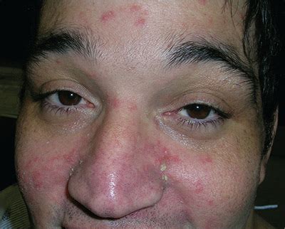 Hiv Rash What Does It Look Like And How Is It Treated Vrogue