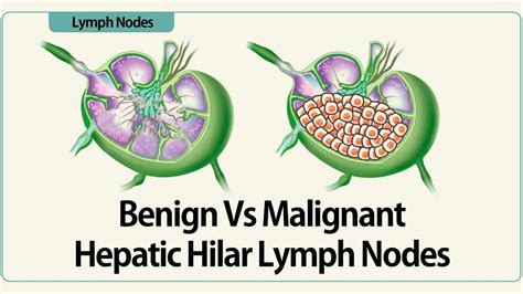 Linear Eus Benign Vs Malignant Hepatic Hilar Lymph Nodes Youtube