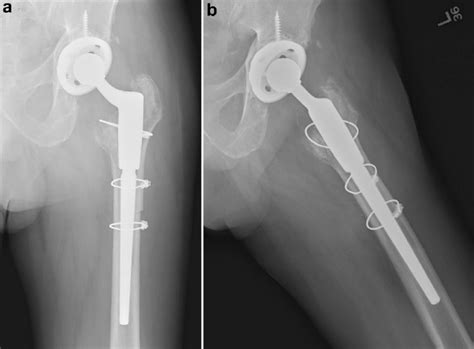 Anteroposterior A And Lateral B Radiographs Of The Left Hip At 3