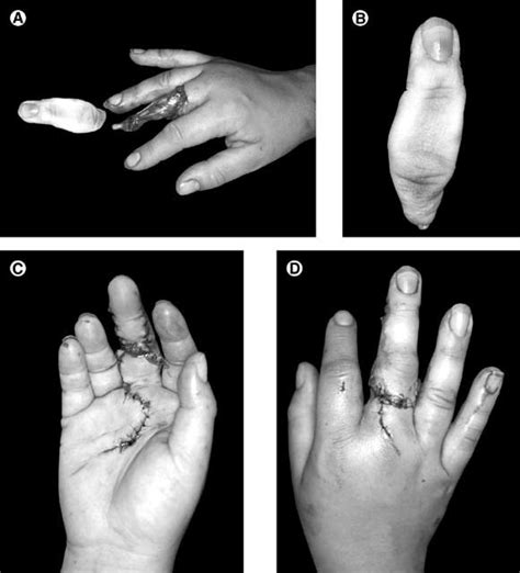 Replantation Of The Upper Extremity Indications And Outcomes Journal