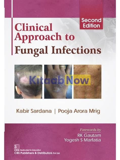 Clinical Approach To Fungal Infections Kitaabnow