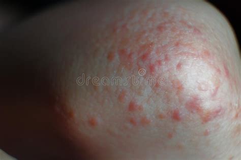 Rash On The Elbow Close Up Red Rash On The Arm Stock Image Image Of