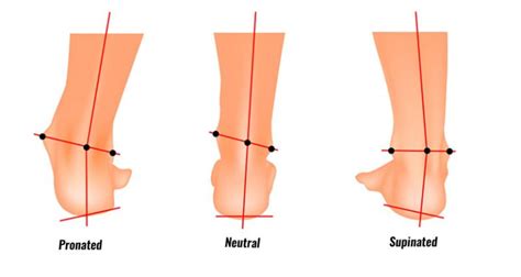 Supination Foot Biomechanics Explained Types Causes And Treatment