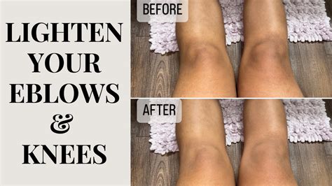 Best Natural Remedies How To Lighten And Brighten Dark Knees And Elbows