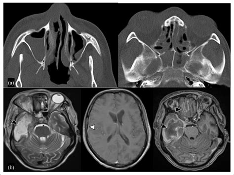 A Axial Ct Of The Paranasal Sinuses Demonstrate Mucosal Thickening